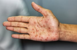 Síndrome de sífilis en fase secundaria (lesiones) en las palmas de la mano. Imagen ilustrativa.