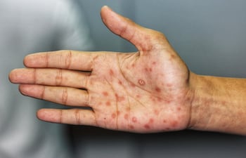 Síndrome de sífilis en fase secundaria (lesiones) en las palmas de la mano. Imagen ilustrativa.