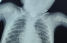 Una radiografía muestra una moneda en el interior de un niño.