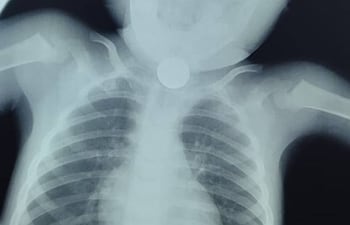 Una radiografía muestra una moneda en el interior de un niño.