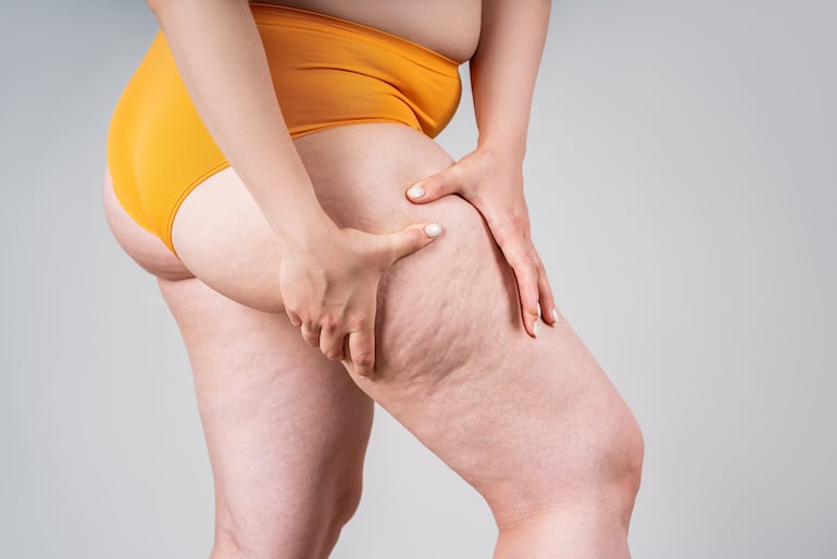 Concepto de celulitis.