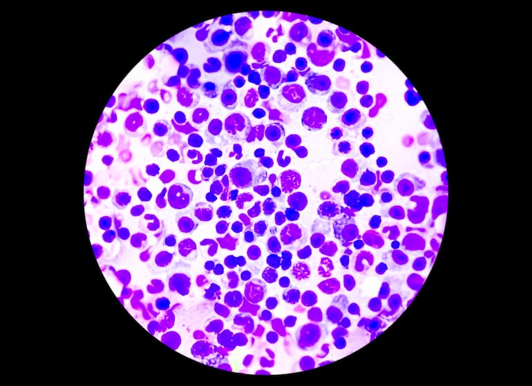 Células de leucemia mieloide crónica o LMC, analizadas por microscopio.