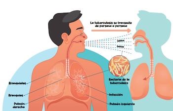 La tuberculosis