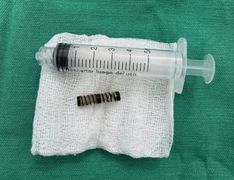 Una niña fue intervenida tras inhalar un resorte que quedó dentro de su organismo.