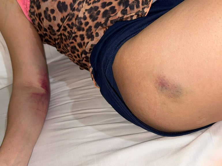 Karina Custodio exhibe moretones en el brazo y muslo, en un entorno interior con fondo blanco.