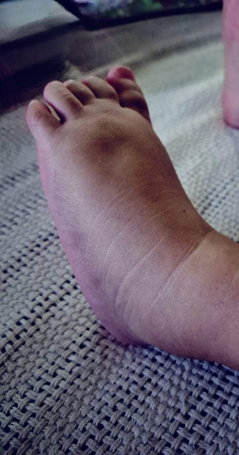 Los pies de  Bianca Sofía, muestran su delicada situación de salud.