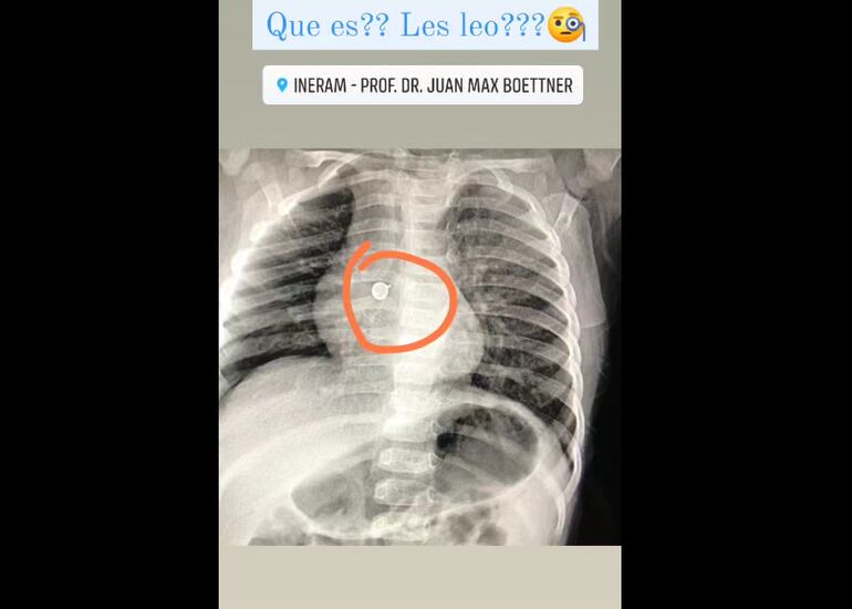 La radiografía del niño con la tacha en su pulmón derecho.