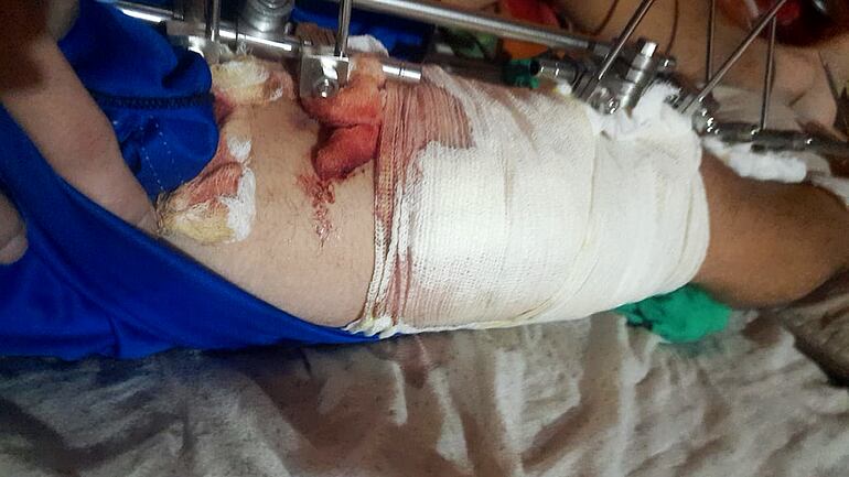 Joven de 19 años, internado en el Hospital de Trauma, espera hace casi un año por una cirugía.