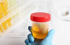 Una mano con un guante de látex sostiene un frasco de laboratorio con orina.