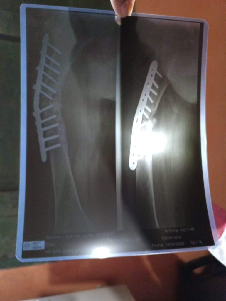 Radiografía de brazo con implante metálico y tornillos, mostrando deformación. Ambiente interior de un estudio médico.