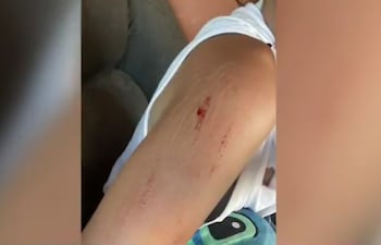 Así quedó el brazo de Natalia Esquivel, supuestamente por la agresión recibida por parte de su primo, un oficial de policía.