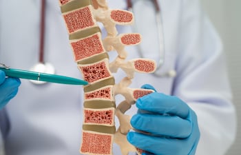 Modelo de osteoporosis.