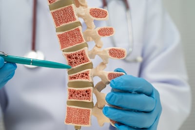 Modelo de osteoporosis.