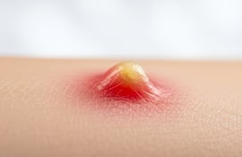 Forúnculo. Imagen ilustrativa.