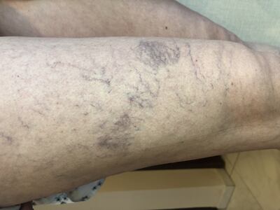 Imagen ilustrativa: las afecciones venosas son muy comunes en Paraguay y más que un problema estético, es un peligroso signo que debe ser tratado.