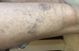 Imagen ilustrativa: las afecciones venosas son muy comunes en Paraguay y más que un problema estético, es un peligroso signo que debe ser tratado.