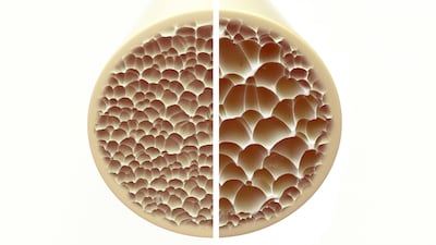 Hueso sano y hueso osteoporosis.