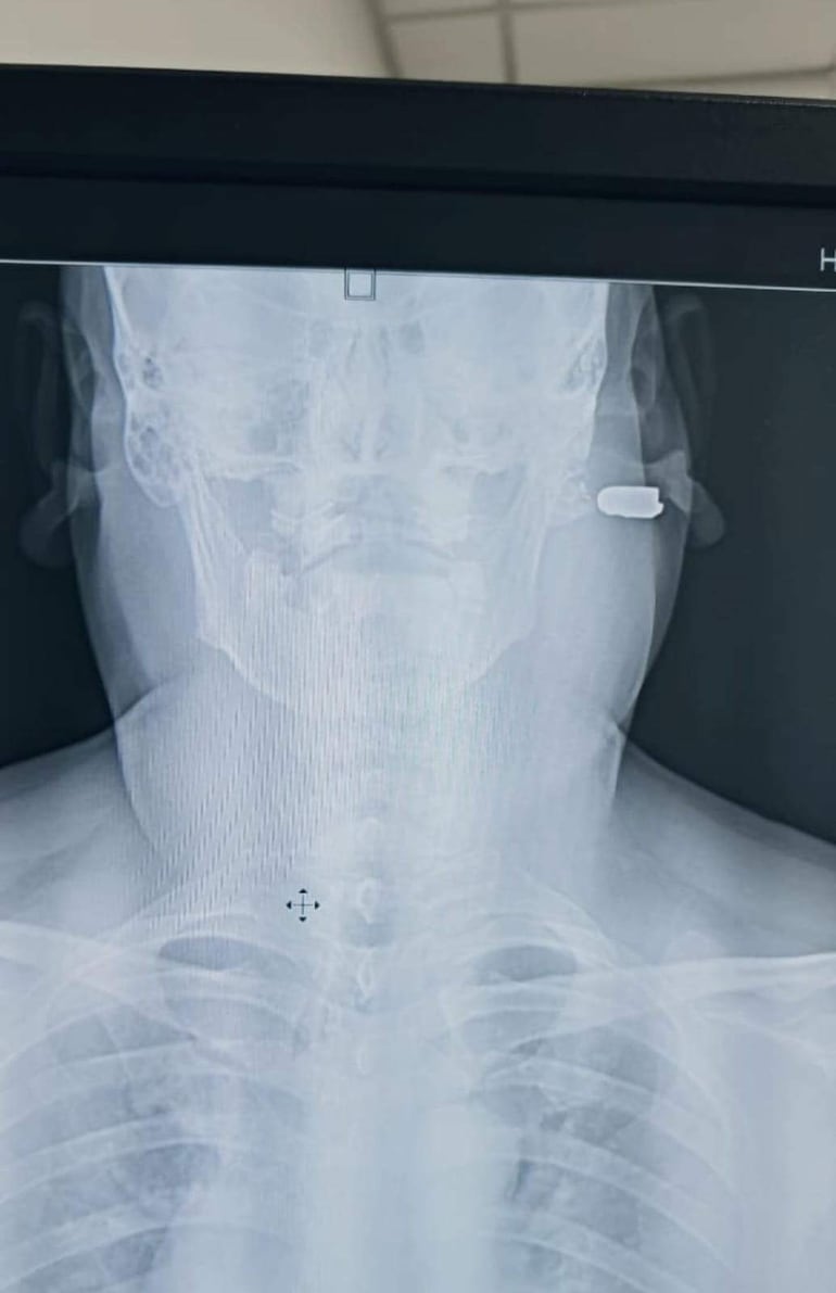 Radiografía del torso superior de un individuo, mostrando estructuras óseas y un posible objeto extraño en la mandíbula.