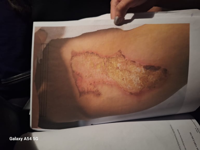 Imagen de una de las quemaduras que sufrió el joven secuestrado.