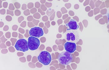 Linfocito atípico en infección viral, imagen ilustrativa.
