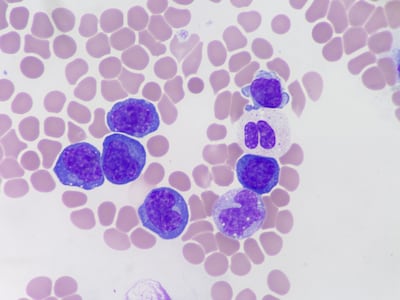 Linfocito atípico en infección viral, imagen ilustrativa.