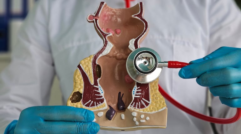 Modelo anatómico del recto con hemorroides, imagen ilustrativa.