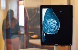 La mamografía hecha a tiempo puede detectar el cáncer de mama, que suele ser silencioso y letal. Imagen referencial.