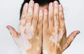 El vitiligo es una enfermedad autoinmune, es la pérdida irregular del color de la piel que suele aparecer en manos y rostro. La afección no es contagiosa ni pone en riesgo la vida de quien la padece.
