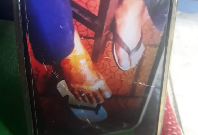 Así quedaron los pies de un poblador del barrio del Naranjo que fue hasta la zona donde salía la humareda. No había ningún incendio pero el suelo estaba muy caliente y sufrió quemaduras.