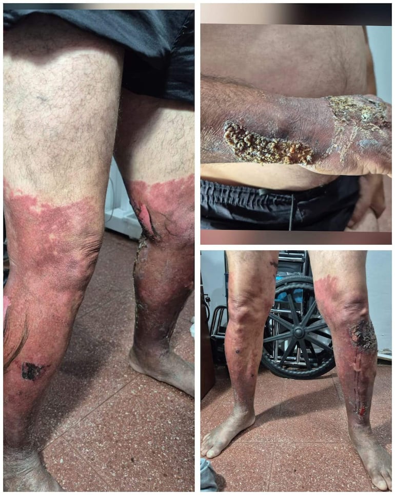 Primer plano de extremidades dañadas de un hombre con lesiones visibles en un entorno doméstico, incluyendo una silla de ruedas.