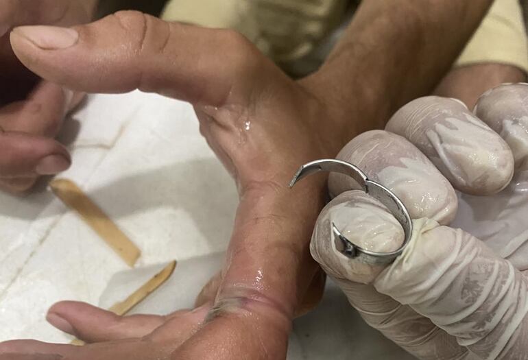 El anillo dejó una visible marca en el dedo.