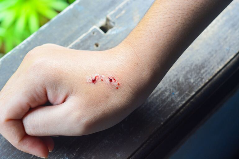 Mano humana con marcas de mordeduras de serpiente.