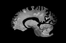 Concepto de enfermedad de alzhéimer.