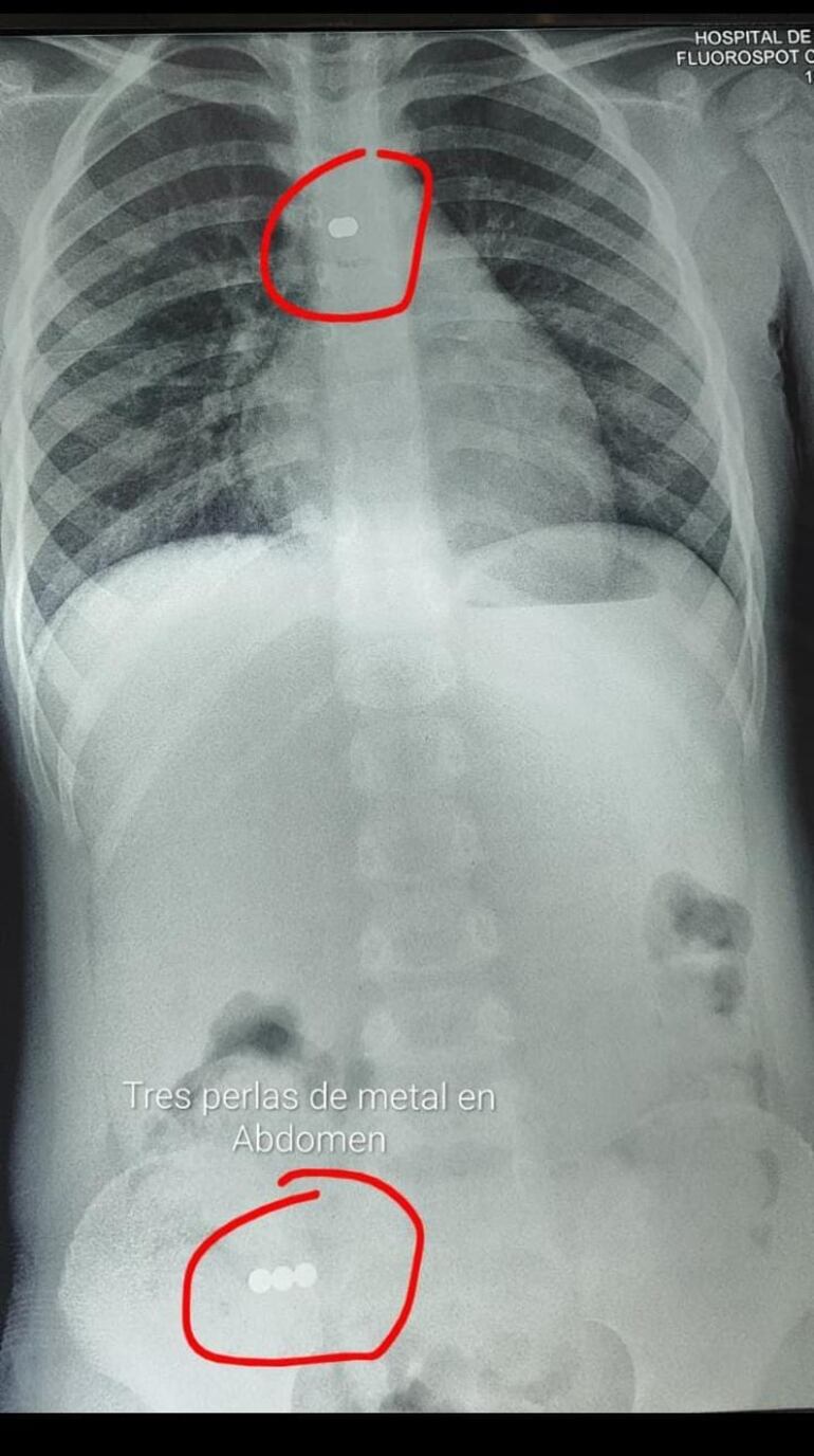 Radiografía donde se observan las perlas en el organismo de la paciente de cuatro años.-