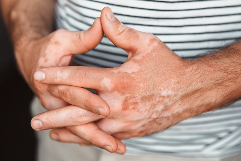 Vitiligo.