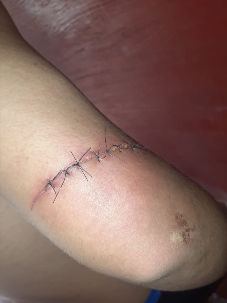 Otra de las heridas sufridas por Cristhian Otazú, en marzo de 2024.
