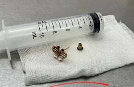 Una bebé de 10 meses tragó un arito y fue intervenida.