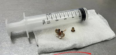 Una bebé de 10 meses tragó un arito y fue intervenida.