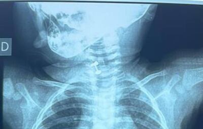 Médicos logran extraer, a tiempo, un arito de las vías aéreas de una criatura de 10 meses de edad.