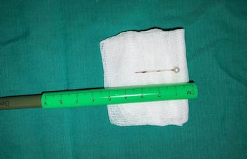 Aguja extraida del sistema de la niña