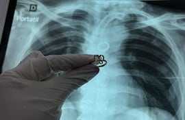 Hallan un anillo de oro dentro del pulmón de un paciente en el Ineram.