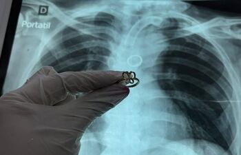 Hallan un anillo de oro dentro del pulmón de un paciente en el Ineram.