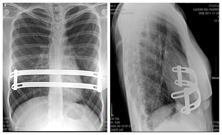 Radiografía que muestra las barras de Lucero Cristal dentro de su pecho, en un ambiente clínico.