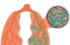 Día Mundial de la Tuberculosis