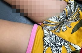 Niña de 6 años quedó con quemaduras luego de que su padrastro le arrojó comida caliente porque no le gustó la comida.