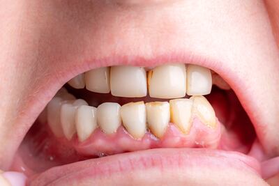 Concepto de cuidado de los dientes, caries, higiene dental.