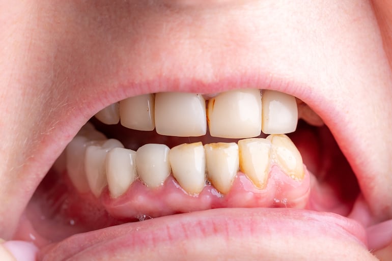 Más allá del azúcar: los verdaderos desencadenantes de las caries