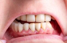 Concepto de cuidado de los dientes, caries, higiene dental.