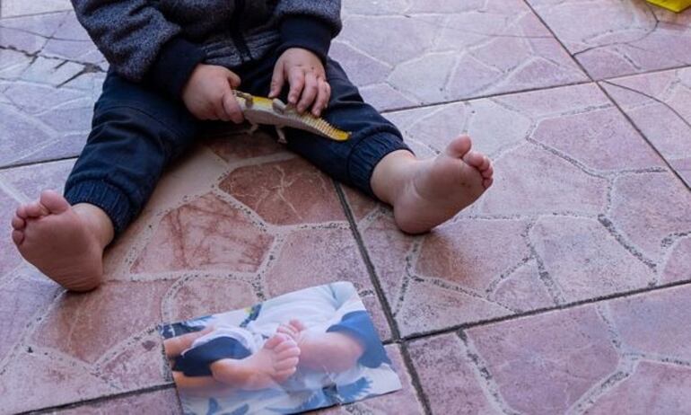 Con el tratamiento adecuado el pie bot se corrige.