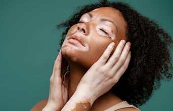 Vitiligo.